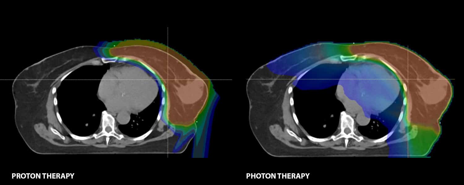 proton vs. photon – breast cancer Breast Cancer - proton therapy vs. photon therapy