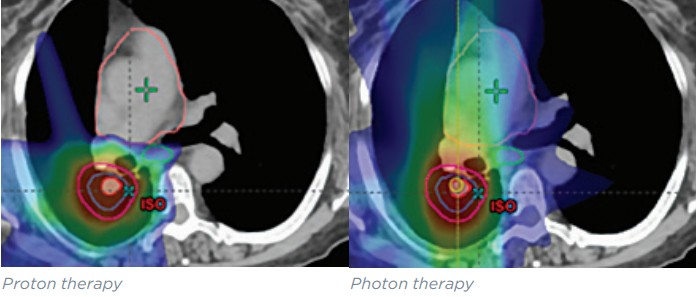 Lung cancer scan comparing proton therapy to photon therapy