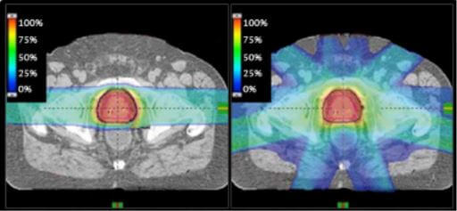 Proton Radiation For Prostate Cancer Doctorvisit 1474