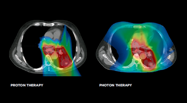 Scan of Lung Cancer Protons vs. Photons in Lung Cancer Case