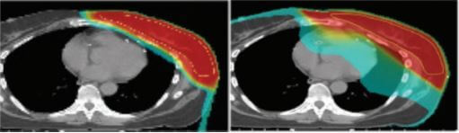 proton therapy for breast cancer versus photon radiation