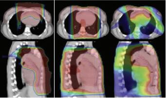 proton therapy for lymphoma versus photon radiation