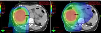 proton therapy for sarcomas versus photon radiation